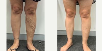 55-64 year old man treated with EVLT - Endovenous laser & phlebectony