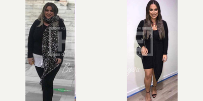 35-44 year old woman treated with Gastric Bypass - Lost 50 kgWe are proud of her