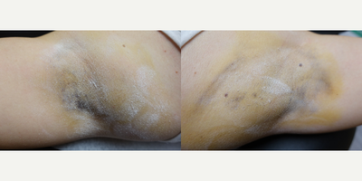 27 year old woman treated with miraDry - This 27 year old female was treated with miraDry, an FDA-cleared, minimally invasive procedure which can be done in the office under local anesthesia. MiraDry has immediate results and most patients only require one treatment. The photos shown are before, using the starch test and 6 weeks later. The dark spots are areas of sweating.