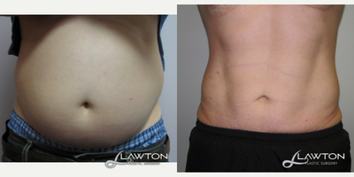 35-44 year old man treated with Liposculpture - 6 months after liposuction