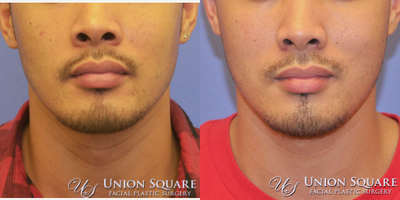 35-44 year old man treated with Alarplasty (nostril narrowing) - Patient requested a conservative and subtle alar base reduction (nostril narrowing) to reduce nasal flare. Procedure was performed under local anesthesia and tolerated very well. 6 day post-op photo displays fresh postoperative incision immediately after sutures were removed.
