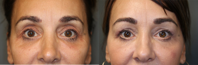 Pan Facial Rejuvenation - Upper and lower lid filler, temple and jawline rejuvenation.