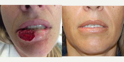 35-44 year old woman treated with Lip Augmentation - 41 y.o. with squamous cell carcinoma of lower lip 1 year after Mohs excision and mucosal advancement flap reconstruction and 1 month after second stage reconstruction with further tissue rearrangement and autologous fat grafting.