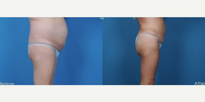 Woman treated with Tummy Tuck - This patient underwent an abdominoplasty with liposuction contouring of the lower back and flanks.