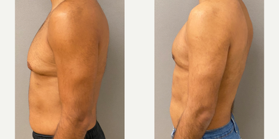 25-34 year old man treated with Gynecomastia Surgery and Liposuction of the abdomen and flanks - 33 yo s/p gynecomastia liposuction with excision and liposuction of the abdomen and flanks performed in our on site AAAA certified operating suite.