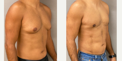 25-34 year old man treated with Gynecomastia Surgery and Liposuction of the abdomen and flanks - 33 yo s/p gynecomastia liposuction with excision and liposuction of the abdomen and flanks performed in our on site AAAA certified operating suite.