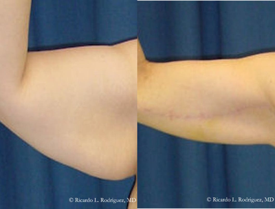 45-54 year old woman treated with Arm Lift - 45-54 year old woman treated with Arm Lift