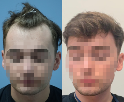 25-34 year old man treated with FUE Hair Transplant - Fue Hair Transplant - 2780 Grafts
