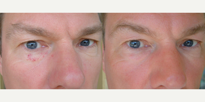 45-54 year old man treated with VeinGogh for bright red facial venous angioma - VeinGogh is excellent for instantaneous removal of facial spider veins and cherry angiomas. No hyper-pigmentation or hypo-pigmentation risks with VeinGogh as may occur with surface laser skin treatments.