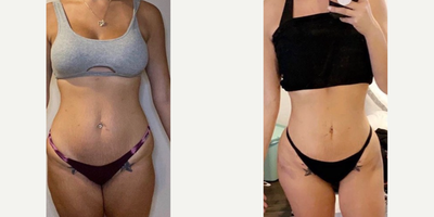 Woman treated with Brazilian Butt Lift - Woman treated with Brazilian Butt Lift