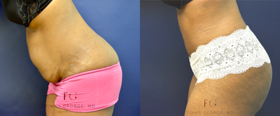 25-34 year old woman treated with Tummy Tuck - This patient underwent an abdominoplasty without complication.