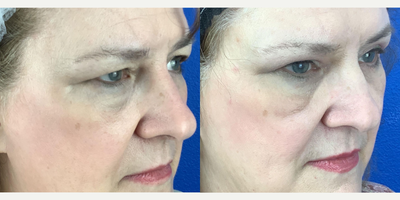 55-64 year old woman treated with Eyelid Surgery - Patients heavy eyelids were restricting vision. Performed bilateral upper blepharoplasty and bilateral brow pexy to open up eyes, thus enabling patient to see without eyelids impeding vision field.