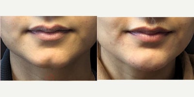 25-34 year old woman treated with Chin Filler, Juvederm, Voluma - Non-surgical Chin augmentation and contouring with filler injection (Voluma, Bellafill, Radiesse)