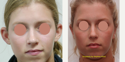 Otoplasty for Prominent ears (Bat Ears) - 17 or under year old young lady with Prominent Ears, treated with Otoplasty
