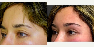 25-34 year old woman treated with Brow Lift - This young woman underwent a rotational endoscopic brow lift