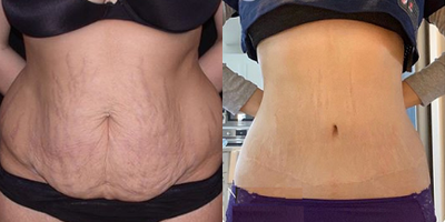 Woman treated with Tummy Tuck - Woman treated with Tummy Tuck