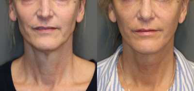 Mini Lift and Lower Lids - Minimally invasive lower facelift.