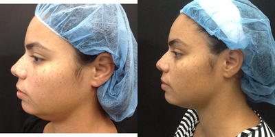 30 year old woman treated with Kybella. - This patient has had submental fullness from childhood. We are posting these photos taken just 3 weeks post op. Her face looks much less round and more oval with the reduction in the fullness under her chin. &nbsp;Additional photos will be posted showing her final results.&nbsp;