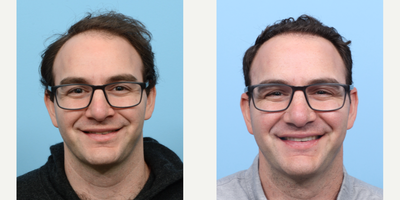 25-34 year old man treated with FUE Hair Transplant, Hair Transplant, Hair Loss Treatment, PRP for Hair Loss - This 33-year-old patient was unhappy with his thin hair and receding hairline. Dr. Wise performed an FUE hair transplant, along with a session of PRP therapy. During the procedure, Dr. Wise transplanted 3,020 grafts to zones 1 and 2 of the scalp to address the patient's concerns and revive the hair that was lost.