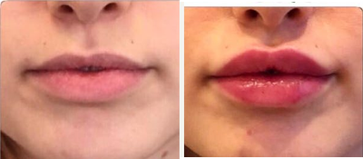 25-34 year old woman treated with Teosyal Kiss - This patient had 1 ml of Teosyal Kiss done followed with 0.5ml of Teosyal Touch Up in 3 weeks after 1st treatment