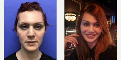Patient treated with Rhinoplasty, Revision Rhinoplasty, Septoplasty - Septorhinoplasty Revision (closed) with Cartilage Grafts - 25 to 34 year-old female patient is 1 month post-op from Facial Feminization surgery. Her procedures included: Forehead Lift, Hairline Lowering, Orbital Bony Contouring, Septorhinoplasty Revision (closed) with Cartilage Grafts, Cheek Implants (small), Chin Reduction and Contour, Soft Tissue to Nasolabial Folds, Intranasal Lip Lift with Fat Augmentation, Thyroid Cartilage Shave Revision and Voice Feminization and 300 Micrografts.