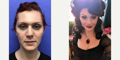 Patient treated with Cheek Augmentation - Cheek Implants (small) - 25 to 34 year-old female patient is 1 month post-op from Facial Feminization surgery. Her procedures included: Forehead Lift, Hairline Lowering, Orbital Bony Contouring, Septorhinoplasty Revision (closed) with Cartilage Grafts, Cheek Implants (small), Chin Reduction and Contour, Soft Tissue to Nasolabial Folds, Intranasal Lip Lift with Fat Augmentation, Thyroid Cartilage Shave Revision and Voice Feminization and 300 Micrografts.