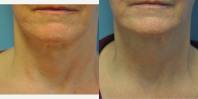 65-74 year old woman treated with ThermiTight - 65 year old female underwent ThermiTight surgery under local anesthesia