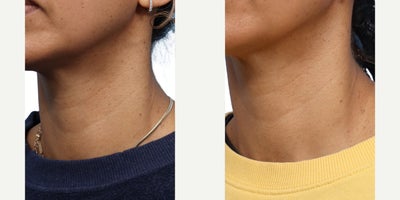 Woman treated with PicoWay - Woman treated with PicoWay