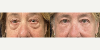 67 year old woman treated with Eyelid Surgery, Facial Fat Transfer - 67 year old woman treated with Eyelid Surgery, Facial Fat Transfer