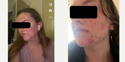 Severe Acne in Isotretinoin - Isotretinoin, commonly known by the brand name Accutane, is a powerful medication used to treat severe acne, particularly recalcitrant nodular or cystic acne, which has not responded to other treatments like antibiotics.Treatment Process:A course of isotretinoin treatment lasts typically 16 to 20 weeks. During this time, patients take one or two pills a day with meals. The dosage is determined based on the patient's body weight and the severity of the acne.Mechanism of Action:Isotretinoin works by decreasing the size and output of sebaceous glands, which produce oil, in the skin. It also helps to promote the rapid turnover of skin cells. This combination reduces the amount of acne-causing bacteria present in the skin and prevents the clogging of pores.Side Effects:Isotretinoin is highly effective, but it also has potential side effects. The most common include dry skin, itching, rash, dry eyes, and nosebleeds. More serious side effects can include changes in vision, severe stomach pain, and mental health issues. Regular monitoring is required to manage these side effects.Pregnancy Warning:Isotretinoin is known to cause serious birth defects, so it's not recommended for use during pregnancy. Women of childbearing age who take isotretinoin are required to use two forms of birth control before, during, and after treatment to prevent pregnancy.Monitoring:Patients on isotretinoin require regular follow-up appointments to monitor their response to the medication and manage any side effects. Blood tests may be conducted to monitor liver function and cholesterol levels, as isotretinoin can affect these.