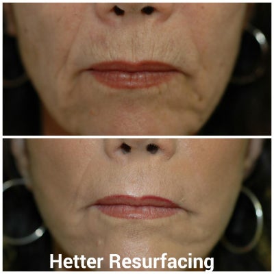 55-64 year old woman treated with Peri Oral Chemical Peel - 55-64 year old woman treated with Peri Oral Chemical Peel