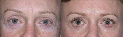 Latisse - 
	A female patient after using Latisse. Her eyelashes are thicker, longer, and darker. To achieve these results, it will take on average 16 weeks.
