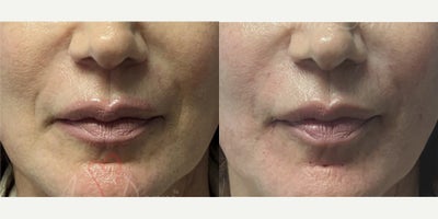 55-64 year old woman treated with Juvederm, Vollure, Restylane - Treatment of nasolabial folds (laugh lines) and marionette lines with Juvederm, Radiesse, Vollure, Restylane or Bellafill injected with cannula