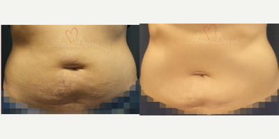 25-34 year old woman treated with SculpSure - Non-surgical removal of stubborn fat in belly and flanks with SculpSure (compare with CoolSculpting)