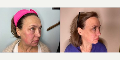 Woman treated with Neo Laser - NeoGen PSR, 2 months post treatment