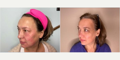 Woman treated with Neo Laser - NeoGen PSR, 2 months post treatment