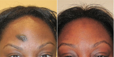 25-34 year old woman treated with Mole Removal - large mole of forehead face removed using plastic surgery techniques