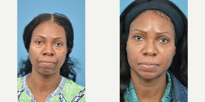 45-54 year old woman treated with Liquid Facelift - 50 year old patient concerned with the all over loss of volume.  A Liquid Facelift was performed to restore the fullness on her temples, lower eyelids, jawline, and lines around the mouth.