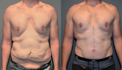 25-34 year old man treated with Male Tummy Tuck - This 30 year old man is 6'4 tall and weighs 215 pounds. He lost 100 pounds with diet and exercise which has left him with significant loose skin. He had enough loose skin that an inverted -T, (also called Fleurs de Lis), type of abdominoplasty was done to achieve the most tightening possible. This technique does leave a scar down the middle, but for this patient, was the better compromise to achieve his desired goal. His old ruptured appendix scar can be seen in the before pictures. The after pictures were taken at nine months.