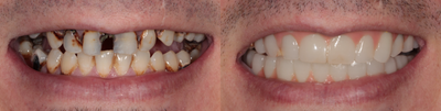25-34 year old man treated with ClearChoice Dental Implants - Upper and Lower Screw in Full arch teeth. In temporary phase due to work stoppage due to COVID 19, will post updated photos when completed.