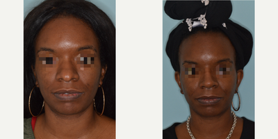 25-34 year old woman treated with African American Rhinoplasty - Before and 6 months after a rhinoplasty procedure