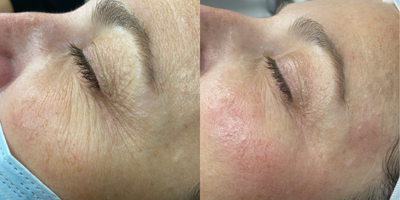 35-44 year old woman treated with TempSure Envi - TempSure Envi for eyes is a radio-frequency laser used to treat fine lines, wrinkles and dry eyes. The best part is collagen will continue to rebuild, enhancing your skin appearance over time. Results are usually visible immediately after the first treatment but will vary from person to person depending on their age, skin type, and skin condition. We recommend a series of 4 sessions to achieve optimal results.