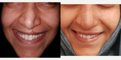 18-24 year old woman treated with Revision Rhinoplasty, Lip Surgery - 24 year old who had a chin implant and neck liposuction