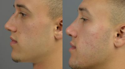 18-24 year old man treated with Nose Surgery - Nose Surgery before and after