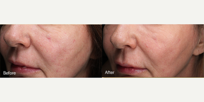 Woman treated with Vivace, LED Light Therapy, Microneedling RF, Skin Rejuvenation - Woman treated with Vivace, LED Light Therapy, Microneedling RF, Skin Rejuvenation