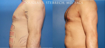 Man treated with Bicep Implants - Man treated with Bicep Implants