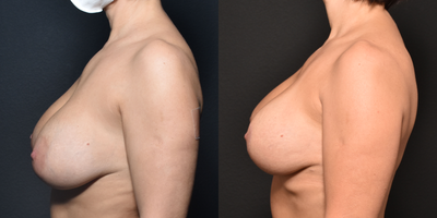 45-54 year old woman treated with Breast Implant Revision, Breast Lift - Bilateral Implant Exchange with lift, Sientra smooth round silicone implants, 215mls each.