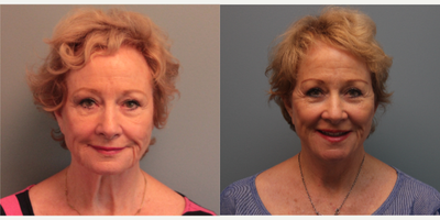 79 year old woman treated with Lifestyle Lift - This 79 year old patient underwent a LiteLift with Dr. , along with a platysmaplasty. She was unhappy with the lines and overall appearance of her face and neck. Through a hairline incision hidden within the ear, under local anesthesia, Dr.reduced the signs of aging around the jaw, neck, and lower face.
