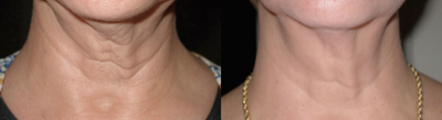 55-64 year old woman treated with Skintyte - Before and after one SkinTyte treatment