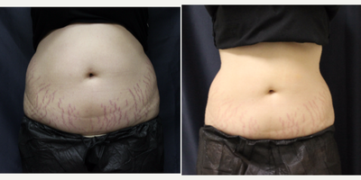 18-24 year old woman treated with SculpSure - Post 6 treatments of SculpSure